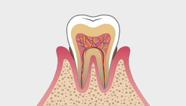 軽度の歯周病