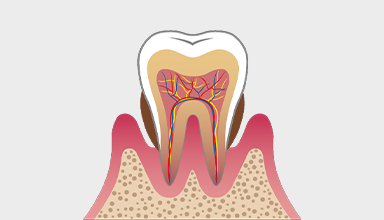 中等度の歯周病