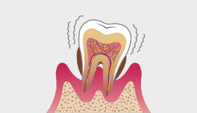 重度の歯周病