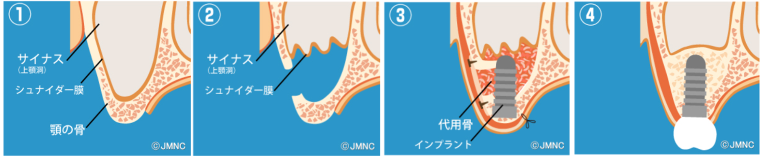 サイナスリフト