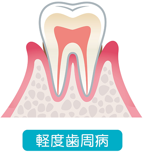 軽度の歯周病（軽度歯周炎）とは？