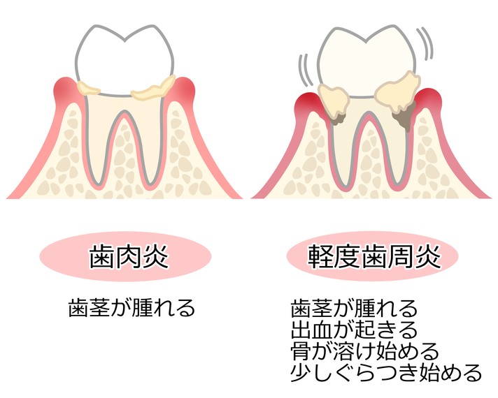 歯肉炎と軽度の歯周病の違いについて