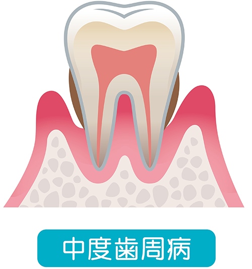 中等度の歯周病（中等度歯周炎）とは