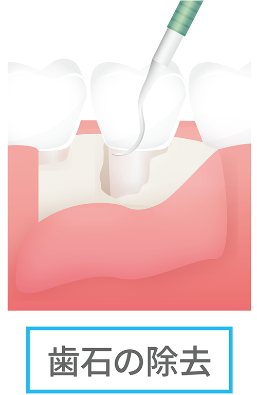 歯周外科治療（フラップ手術）