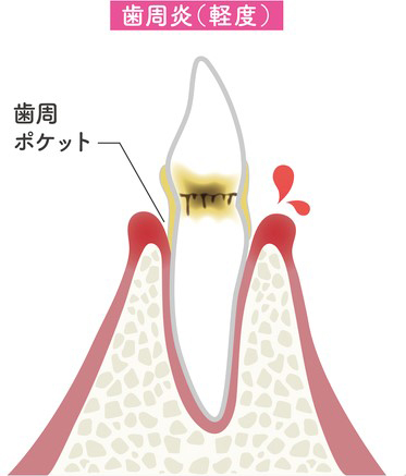 軽度の歯周炎