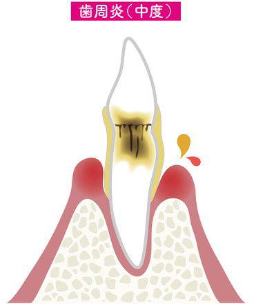 中等度の歯周炎
