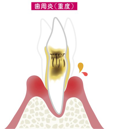 重度の歯周炎