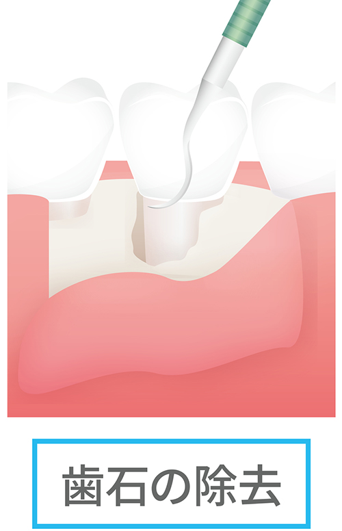 フラップ手術（歯肉剥離掻爬手術）