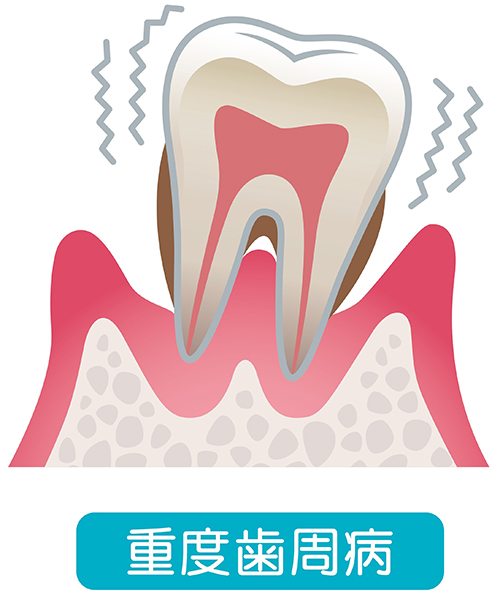 重度の歯周病（重度歯周炎）とは