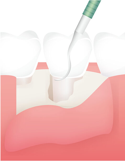 歯周外科治療（フラップ手術）