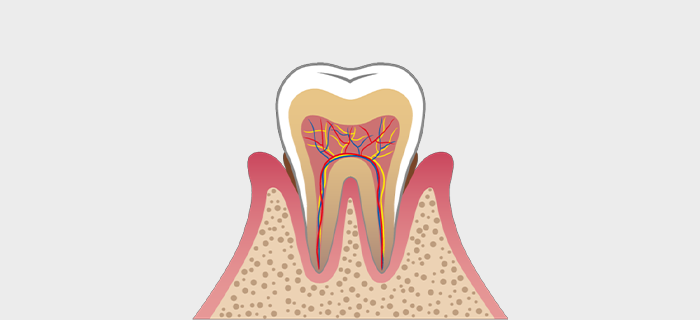 軽度の歯周病