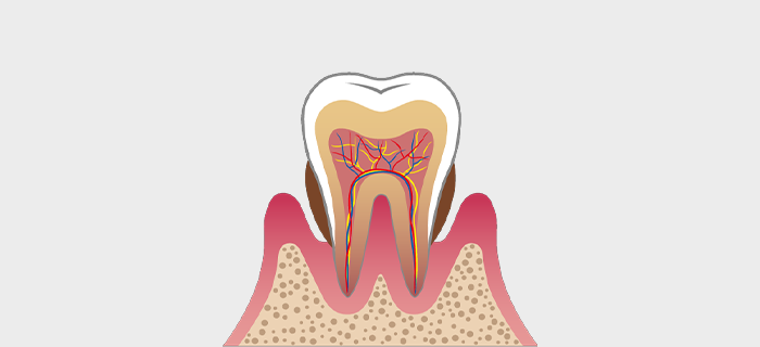 中等度の歯周病