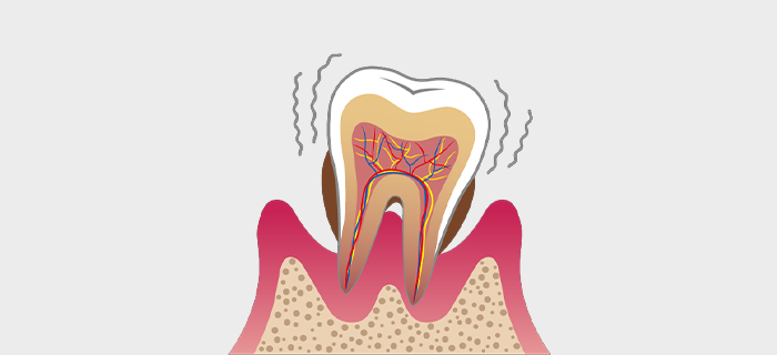 重度の歯周病