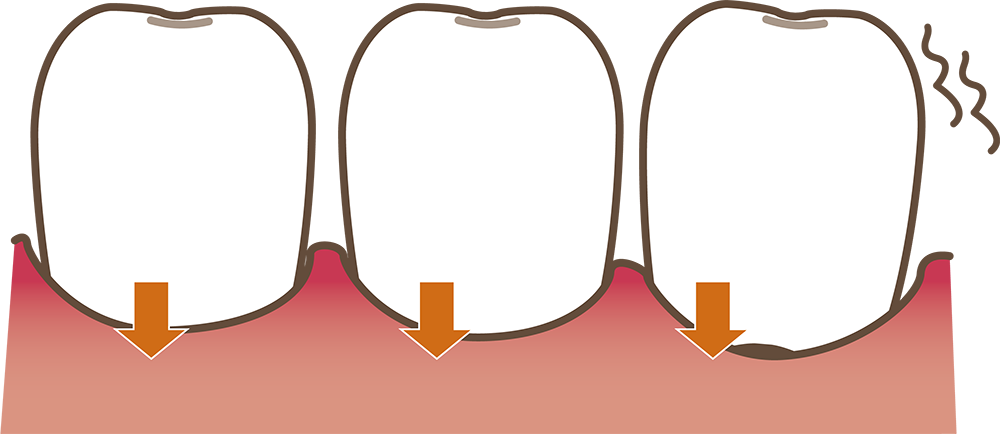 歯ぐきが下がってきた