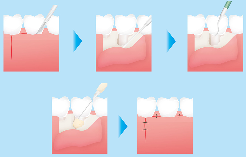 歯周組織再生療法 ｜エムドゲイン・リグロス・CGF再生療法対応の歯周病 